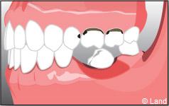 Pour remplacer les dents manquantes