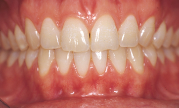 Pour remplacer les dents manquantes