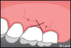 Chirurgie mucogingivale