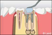 traitement radiculaire